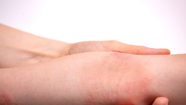 Atopijski dermatitis