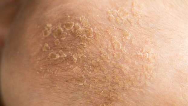 Seborrheic dermatitis