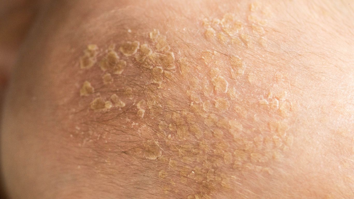 Seboreični dermatitis: Kako prepoznati simptome i uspešno kontolisati seboreju